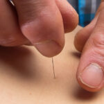 Uncover Long-lasting Pain Relief With Dry Needling!